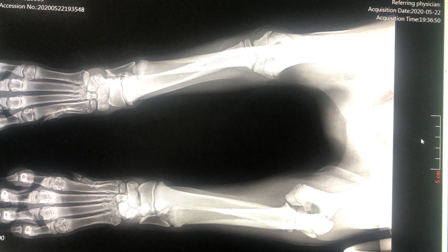 關節肘頭與冠狀骨斜骨折。經兩個小時手術，將斷骨聯結