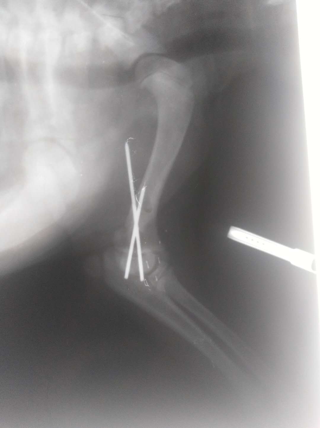 關節肘頭與冠狀骨斜骨折。經兩個小時手術，將斷骨聯結